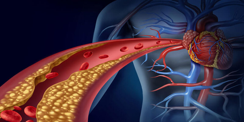 Ateroskleróza – kôrnatenie ciev